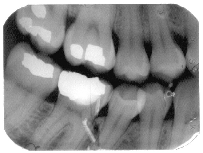 Scan of one intraoral X-ray film.