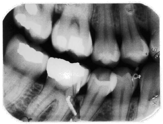 Bite-wing dental X-ray film, scanned and enhanced with histogram equalization.