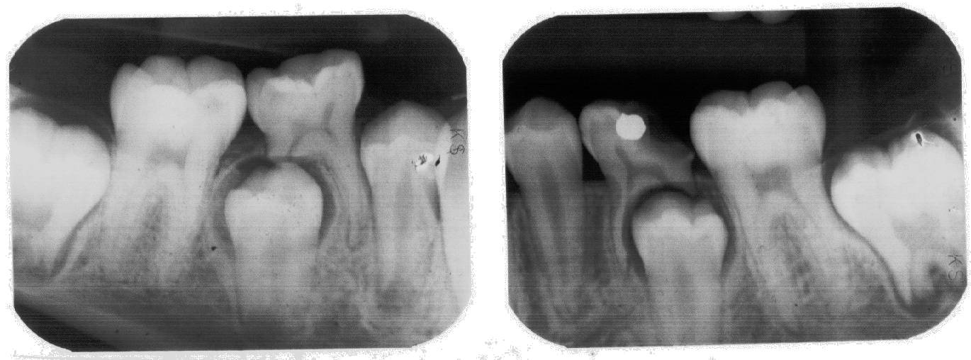 Two intraoral x-ray films.