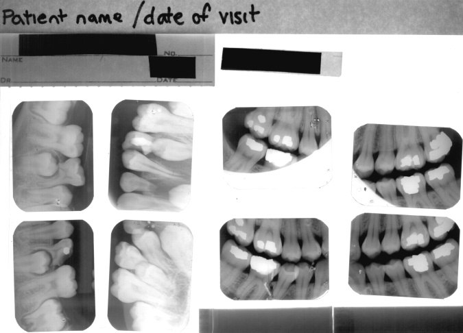 Downsampled scan of 8 intraoral X-ray films.