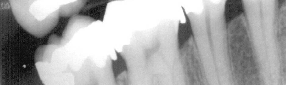 Bite-wing X-ray image of teeth.