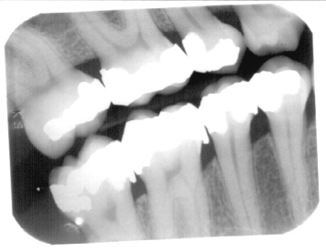 Bite-wing dental X-ray film.