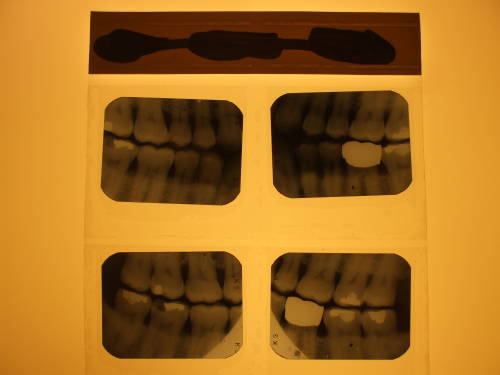 X-ray dental full mouth series in plastic carrier.