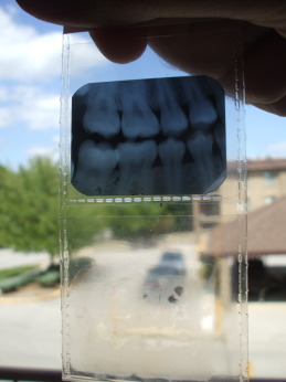 X-ray film and sleeve with clouding.
