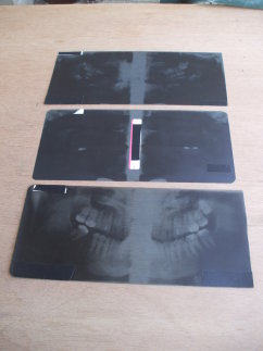 Three extraoral panoramic dental X-ray films.