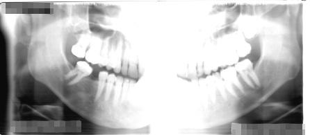 Bite-wing dental X-ray film.