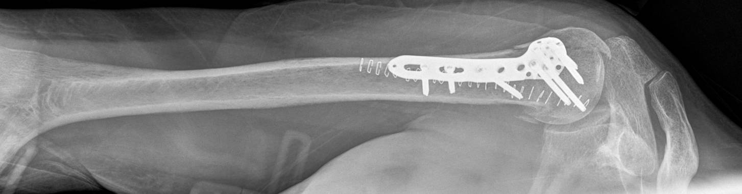 A shoulder injured through Crom-Fu.  Humoral head fracture, open reduction and internal fixation using an adamantium plate.